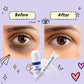 Carphin Eye Care Bundle Dark Circles & Puffiness - Caremon