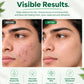 Acnipеx Cleanser for Oily & Acne Prone Skin 150ml